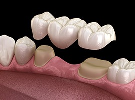 Illustration of dental bridge in East Brunswick, NJ being placed on teeth
