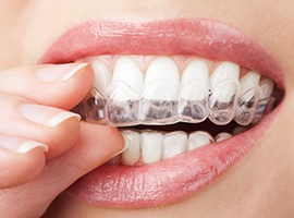 Closeup of smile with Invisalign tray