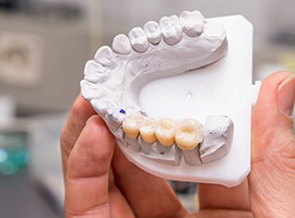 Model of smile with dental crown supported fixed bridge after restorative dentistry